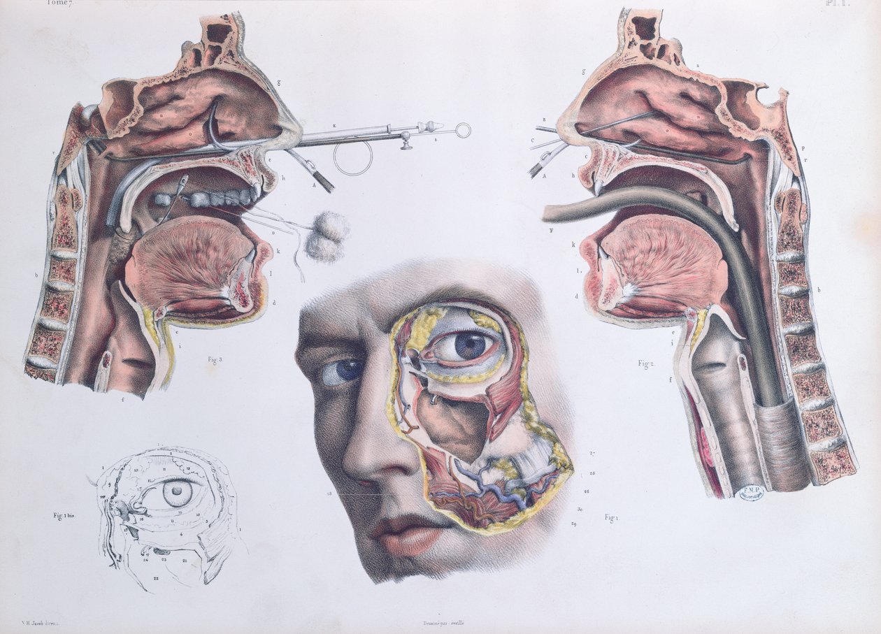 一项鼻腔手术，由Jean-Baptiste Marc Bourgery撰写的“人类解剖学完整论文”（1797-1849）1866-67 作者 尼古拉斯·亨利·雅各布