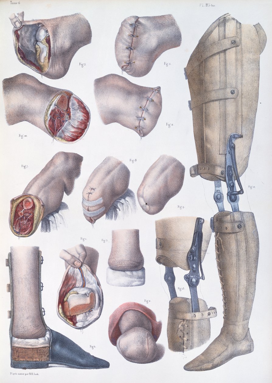 截肢和假肢，来自“人类解剖学的完整论述”，作者：Jean-Baptiste Marc Bourgery（1797-1849）1866-67 作者 尼古拉斯·亨利·雅各布