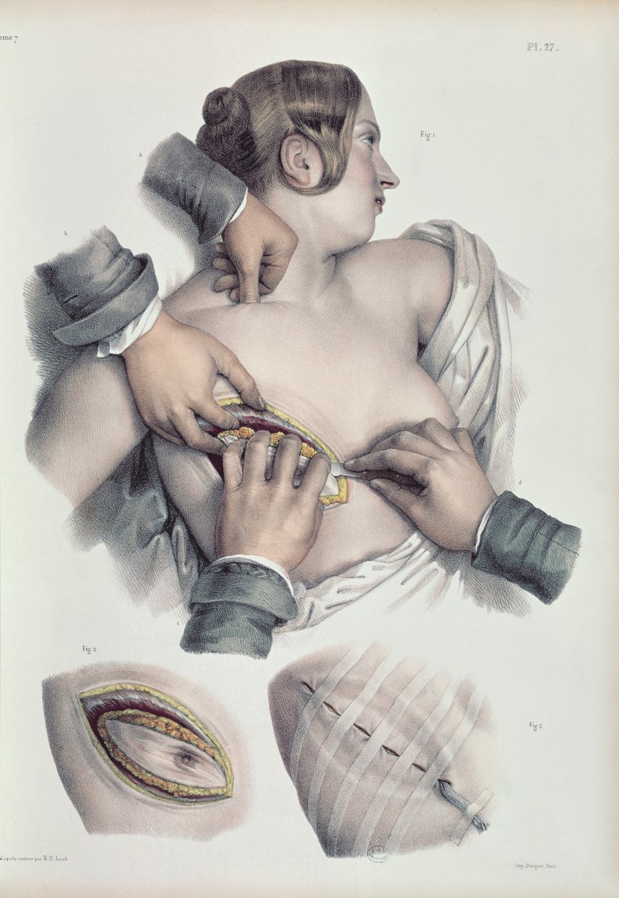 关于癌性肿瘤，来自Jean-Baptiste Marc Bourgery（1797-1849）1866-67的“人类解剖学完整论述” 作者 尼古拉斯·亨利·雅各布