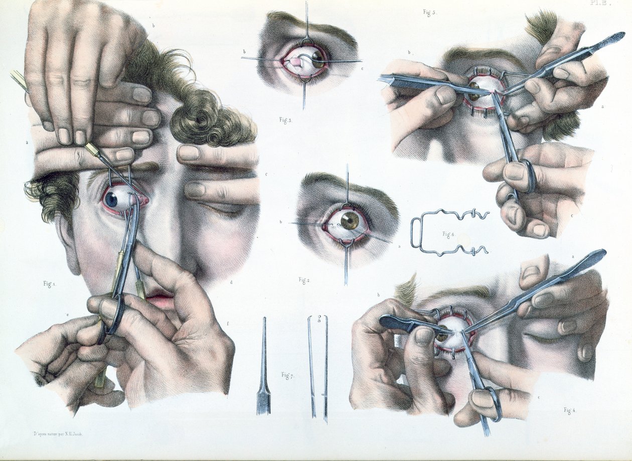 斜视手术，由Jean-Baptiste Marc Bourgery撰写的“人类解剖学完整论述”（1797-1849）1866-67 作者 尼古拉斯·亨利·雅各布