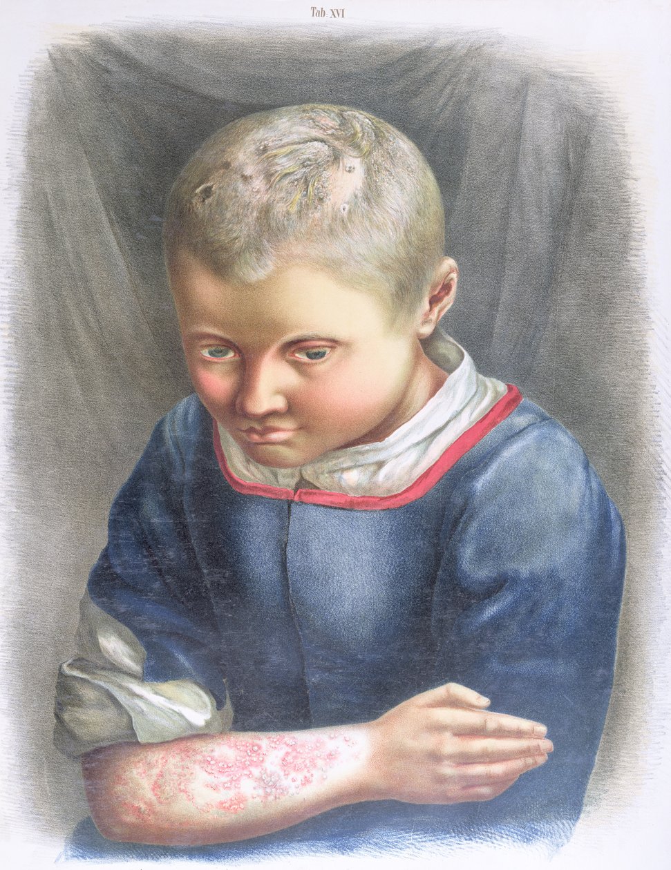 Favus，来自Daniel Cornelius Danielssen（1815-94）1892年出版的一本书 作者 挪威学校