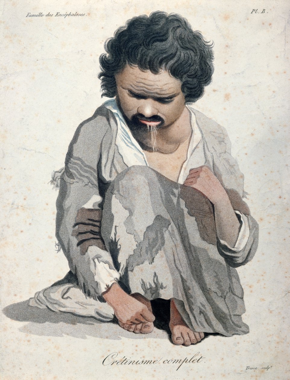 完全克汀病，来自Baron Jean Louis Alibert（1768-1837）的一本书 作者 萨尔瓦多·特雷斯卡