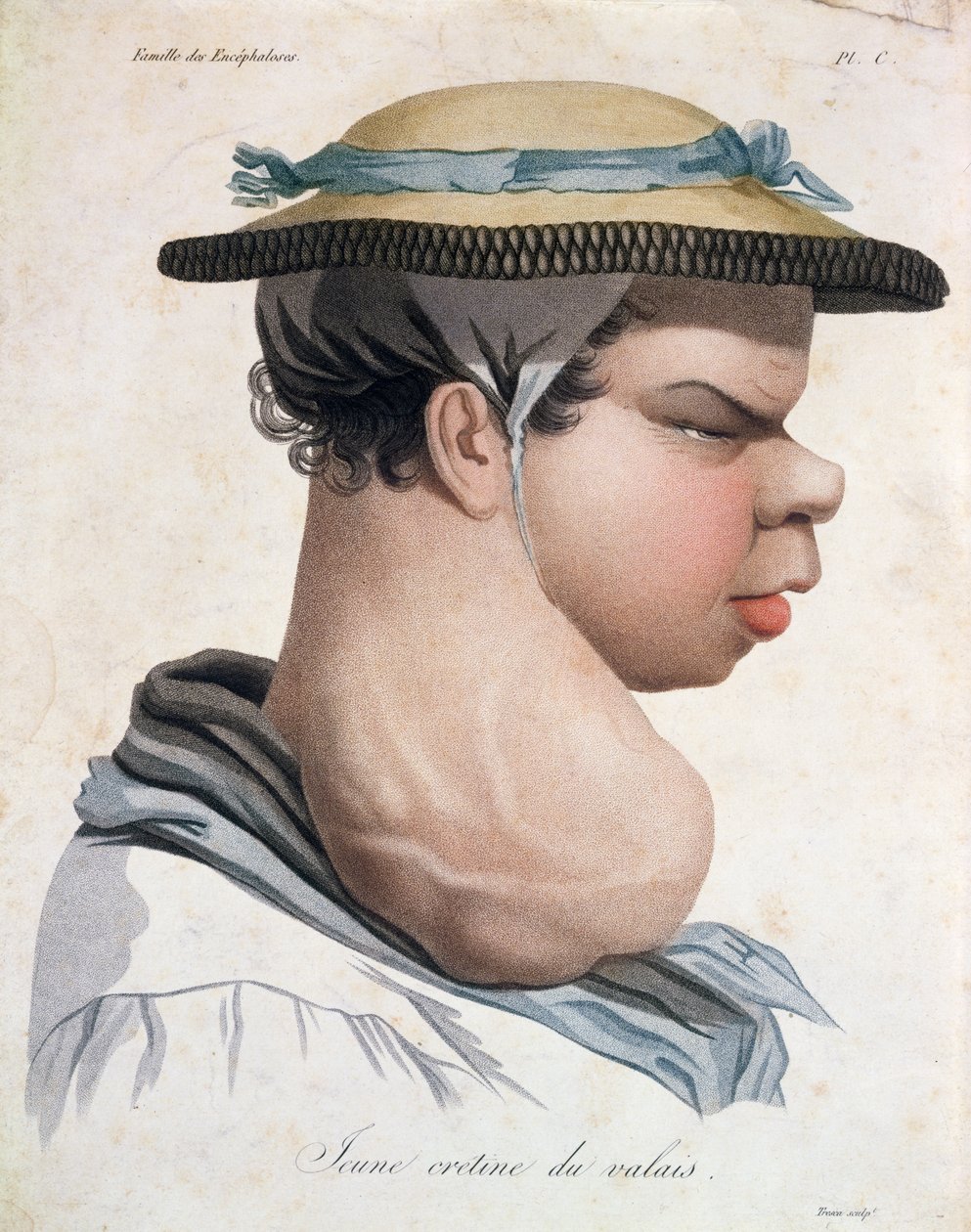 来自瓦莱州的年轻Cretin，来自男爵Jean Louis Alibert（1768-1837）的书中的插图 作者 萨尔瓦多·特雷斯卡