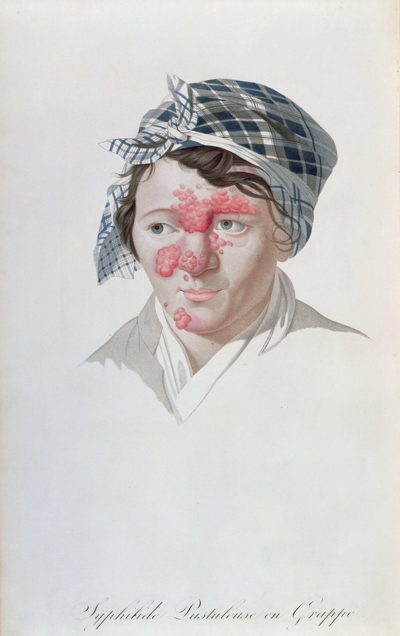 Syphilic cluster pustules，来自Baron Jean Louis Alibert（1768-1837）1838年的一本书 作者 萨尔瓦多·特雷斯卡