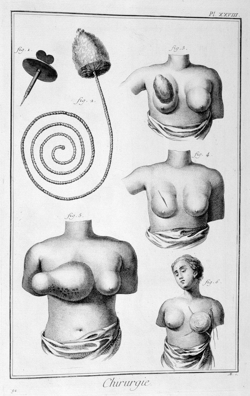 乳房手术，1751-1777年 作者 不明