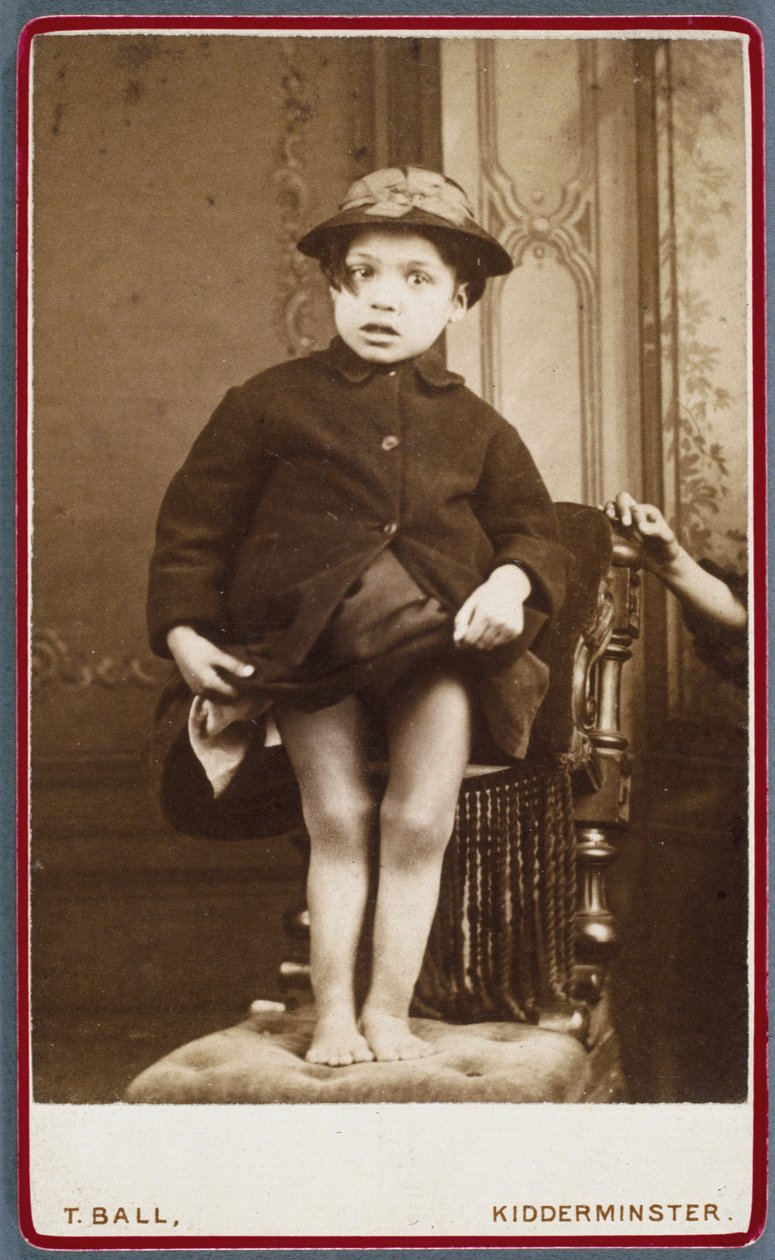 Diseases, Rickets (Rachitisme, jambes rachitiques) Child with rickets 作者 不明