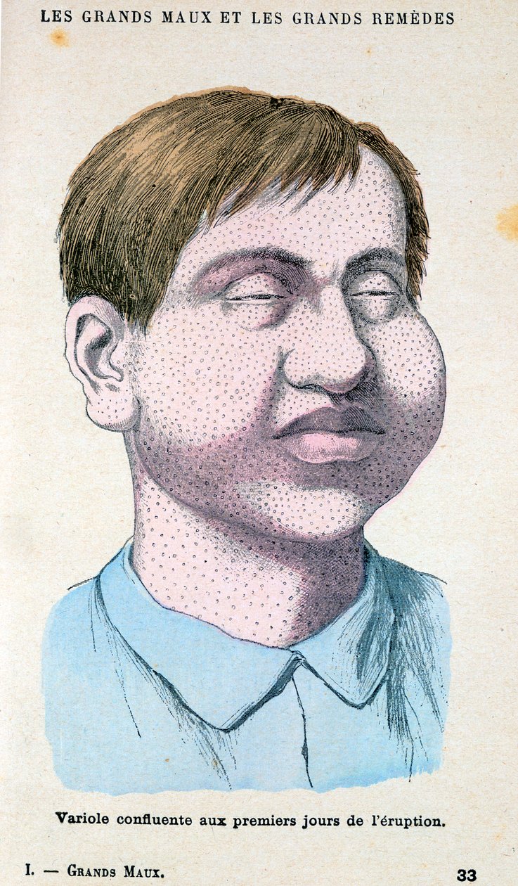 天花受害者，c1890 作者 不明