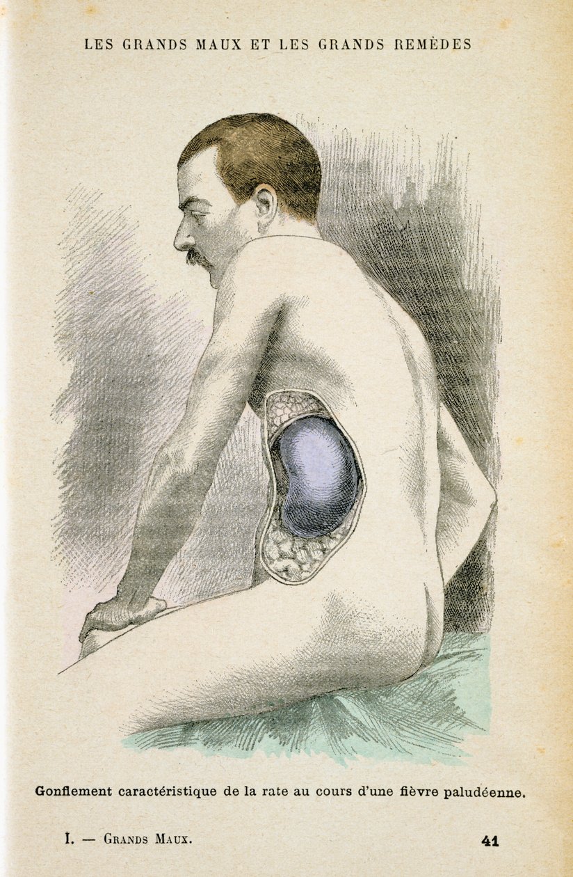 疟疾患者的典型脾脏增大，c1890 作者 不明