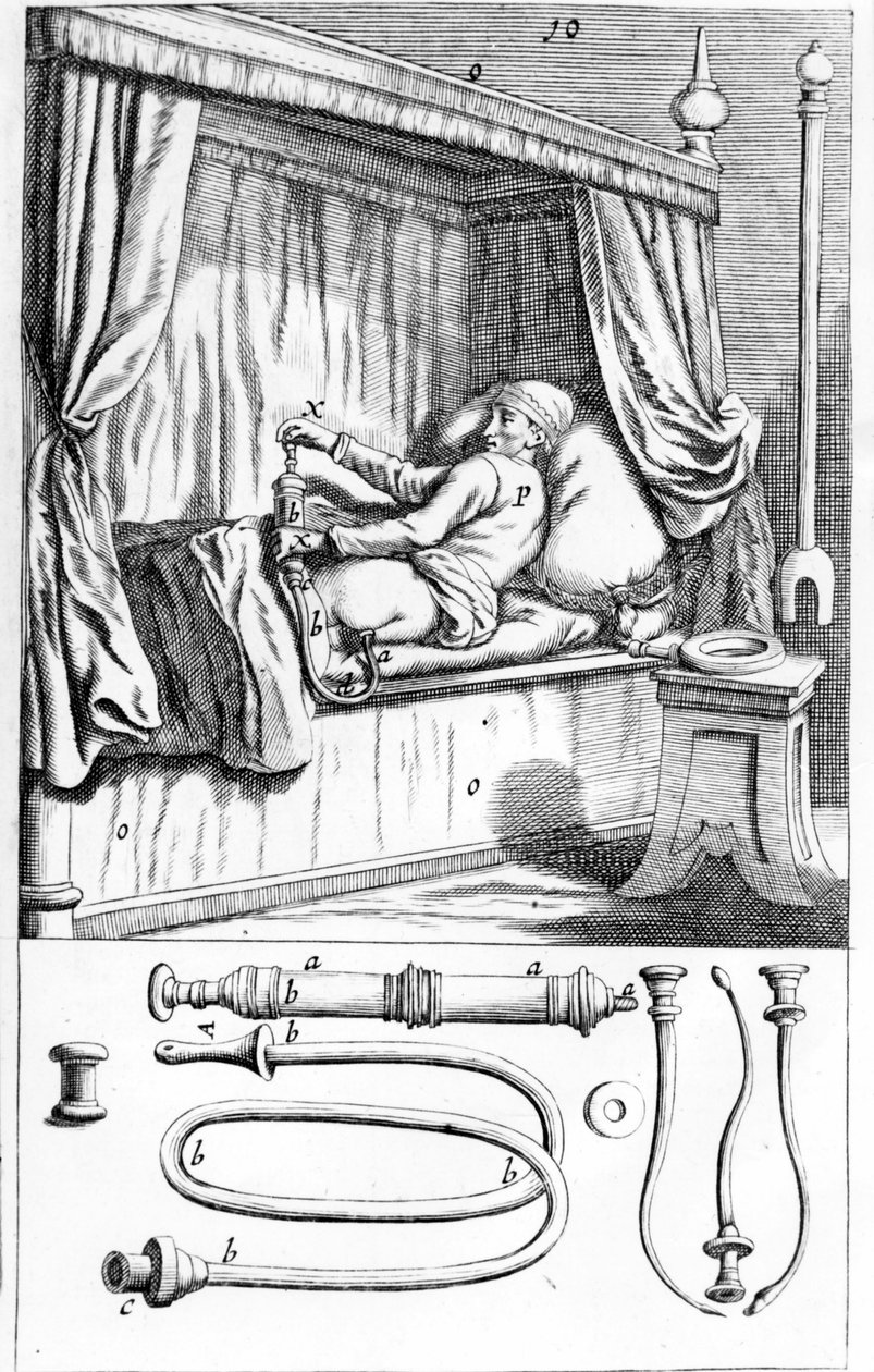 Clystère（用于灌肠）由 Johannes Sculptetus “” Armamentarium Surgical”。 威尼斯 1665 作者 未知艺术家