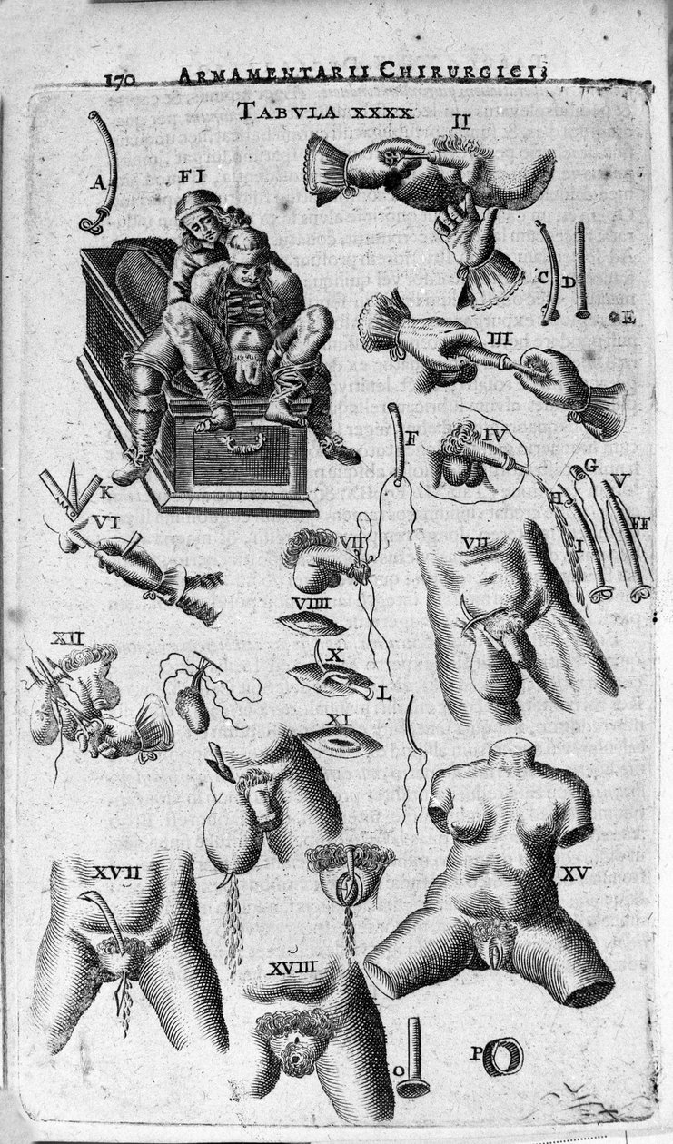 对女性和男性的外科干预。 威尼斯 J. Scultetus 的“Armamentarium Surgical”雕刻 作者 未知艺术家