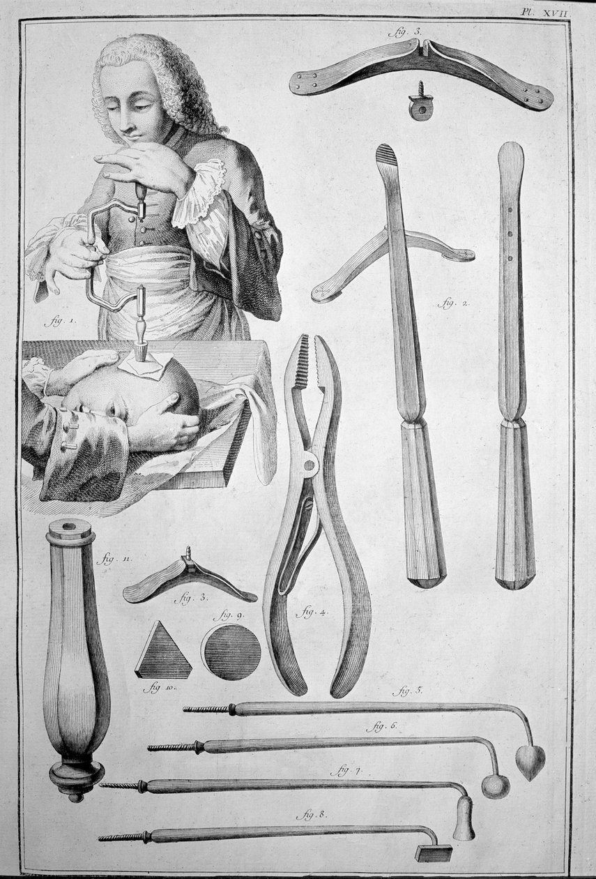 Trepanation of the skull, various instruments (engraving 作者 未知艺术家