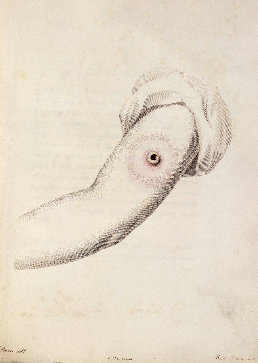 手臂上的牛痘脓包，来自爱丽丝詹纳（1749-1823）的“对天竺葵的原因和影响的探究”，由Pearce雕刻，c.1800 作者 威廉·斯克尔顿