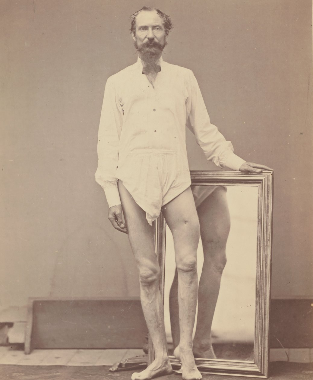 左股骨中三分之一处的枪伤，1865-67年。 作者 威廉·贝尔