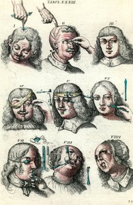 Surgery in the 18th century: Trepanation and operation of the eye and face. Engraving in “Institutionis chirurgicae” by Lorenzo Heister 作者 匿名匿名