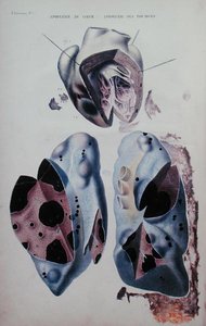 心脏和肺部窒息症，插图来自让-克鲁维耶（Jean Cruveilhier）（1791-1874）的《人体解剖学》，在巴黎出版。
