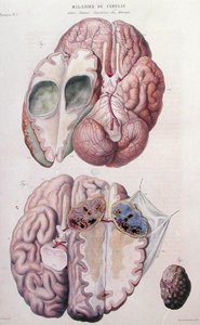 脑部癌性肿瘤，摘自让-克鲁维耶（Jean Cruveilhier，1791-1874）1828-42的《人体解剖学》（彩色雕刻）。