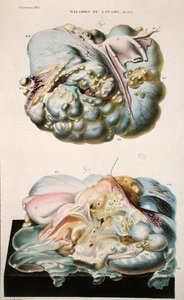 卵巢疾病，摘自让-克鲁维耶（Jean Cruveilhier）（1791-1874）1828-42的《人体解剖学》（彩色版画）。