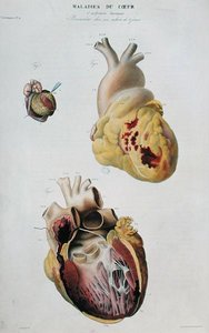 描绘心脏疾病的板块。一位86岁妇女的心脏自发破裂（图1）和一个6天大的婴儿的心包炎（图2），摘自Jean Cruveilhier（1791-1874）的《人体解剖学》，在巴黎出版。