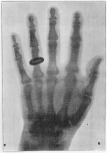 伦琴妻子安娜-贝莎-路德维希左手的 X 光片 作者 卡尔·奥古斯特·沃勒