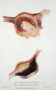 胃的软化和滤泡性溃疡，摘自《新生儿和产妇疾病手册》，作者是Charles-Michel Billard，由Stassel刻制。 作者 查尔斯·米歇尔（后）台球