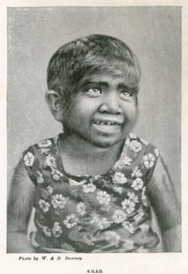 Krao，The Missing Link，于1887年在伦敦威斯敏斯特水族馆展出 作者 英国摄影师