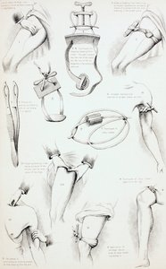 遏制出血的方法，c.1890 作者 英语学校