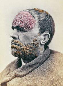 患有梅毒的男子，照片拍摄于1868年的胭脂红摄影 作者 法语学校