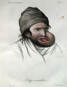 上颌骨息肉，摘自让-路易斯-阿里伯特男爵（1768-1837）的书 1817年（彩色雕刻）。 作者 法语学校