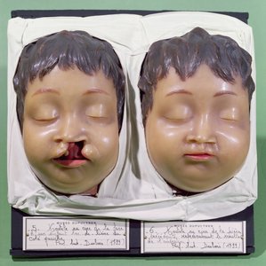 模特展示了一个孩子的脸，在1799年由Antoine Dubois（1756-1837）执行的操作之前和之后纠正了一个harelip（蜡） 作者 法语学校