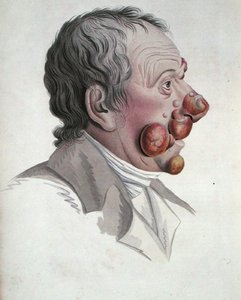 Fongoide霉菌病，摘自Jean Louis Alibert男爵（1768-1837）的著作 1838年（彩色雕刻）。 作者 法语学校