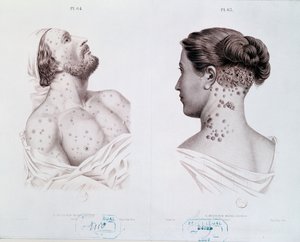 男性和女性梅毒的症状，来自医学书，第1850-60页 作者 法语学校