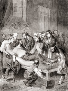 1846 年，美国牙医威廉·托马斯·格林·莫顿 (William Thomas Green Morton) 首次公开展示了使用吸入乙醚作为手术麻醉剂，来自《科学之家》(Les Merveilles de la Science)，出版于 1870 年 作者 法语学校