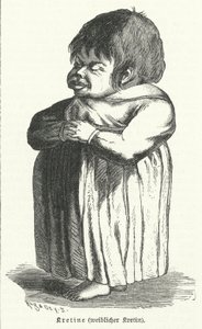 Cretin，患有先天性碘缺乏症的妇女（雕刻） 作者 德国学校