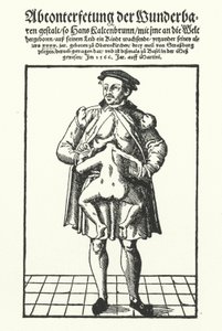 Hans Kaltenbrunn 和他未开发的连体双胞胎（雕刻） 作者 德国学校