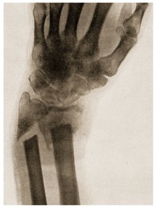 手腕骨折的X射线c.1890 作者 德国学校