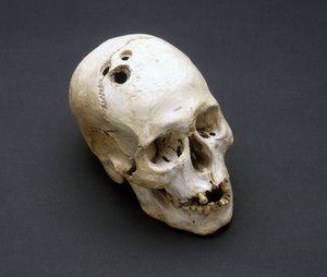 Trephination 青铜时代头骨，巴勒斯坦耶利哥，公元前 2200-2000 年 作者 未知未知