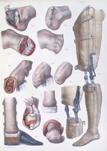 截肢和假肢，来自“人类解剖学的完整论述”，作者：Jean-Baptiste Marc Bourgery（1797-1849）1866-67