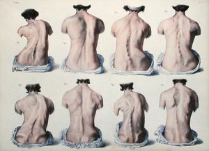 脊柱畸形，板块来自让-巴蒂斯特-马克-布尔热（1797-1849）的《人体解剖学全书》1866-67（彩色雕刻）。 作者 尼古拉斯·亨利·雅各布
