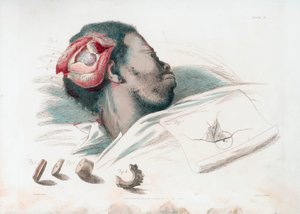 颅内伤口的视图，在左下角进行切开和切除破碎的骨片后，1821年 作者 托马斯·兰西尔