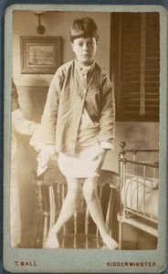 疾病, 佝偻病 (Rachitisme, jambes rachitiques) 患有佝偻病的儿童 作者 不明