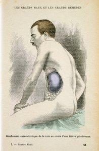 疟疾患者的典型脾脏增大，c1890 作者 不明