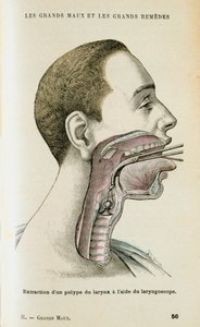 使用喉镜帮助从喉咙取出息肉，c1890 作者 不明