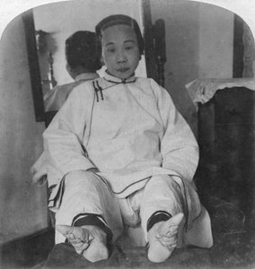 一位高种姓的女士精致百合脚，展现出畸形的方法，中国，1900年。