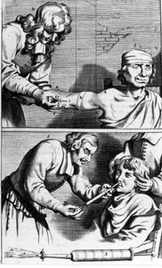Johannes Sculpteti “Armamentarium Surgery” 阿姆斯特丹 1672 的流血和鼻腔淋浴 作者 未知艺术家