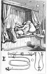 Clystère（用于灌肠）由 Johannes Sculptetus “” Armamentarium Surgical”。 威尼斯 1665 作者 未知艺术家