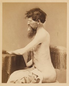 二等兵约翰-巴尔（John Bar），腹部穿透伤后的恢复情况，左腹股沟骨折，摘自外科图片目录 作者 威廉·贝尔