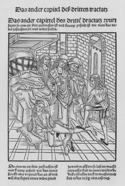 The Book of Cirurgia by Hieronymus Brunschwig (litho) 作者 （之后）德国学校