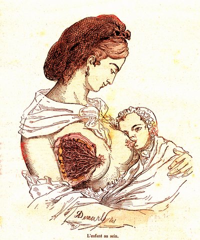 乳房中的孩子（J. Rengade 的正常生活与健康）--母乳喂养。A. Demarle 绘制于 1881 年 作者 阿方斯·德马尔