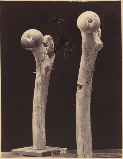 股骨枪伤骨折标本，约 1867 年（照片1867 年（照片） 作者 美国摄影师