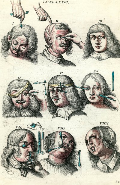 Surgery in the 18th century: Trepanation and operation of the eye and face. Engraving in “Institutionis chirurgicae” by Lorenzo Heister 作者 匿名匿名